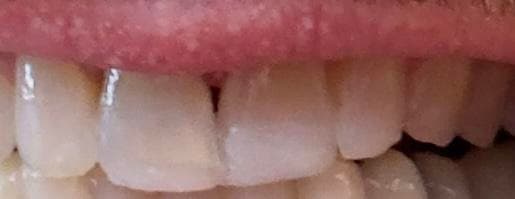 Restored front tooth after cosmetic bonding by Dr. Daniel Meader CDT, Columbia SC