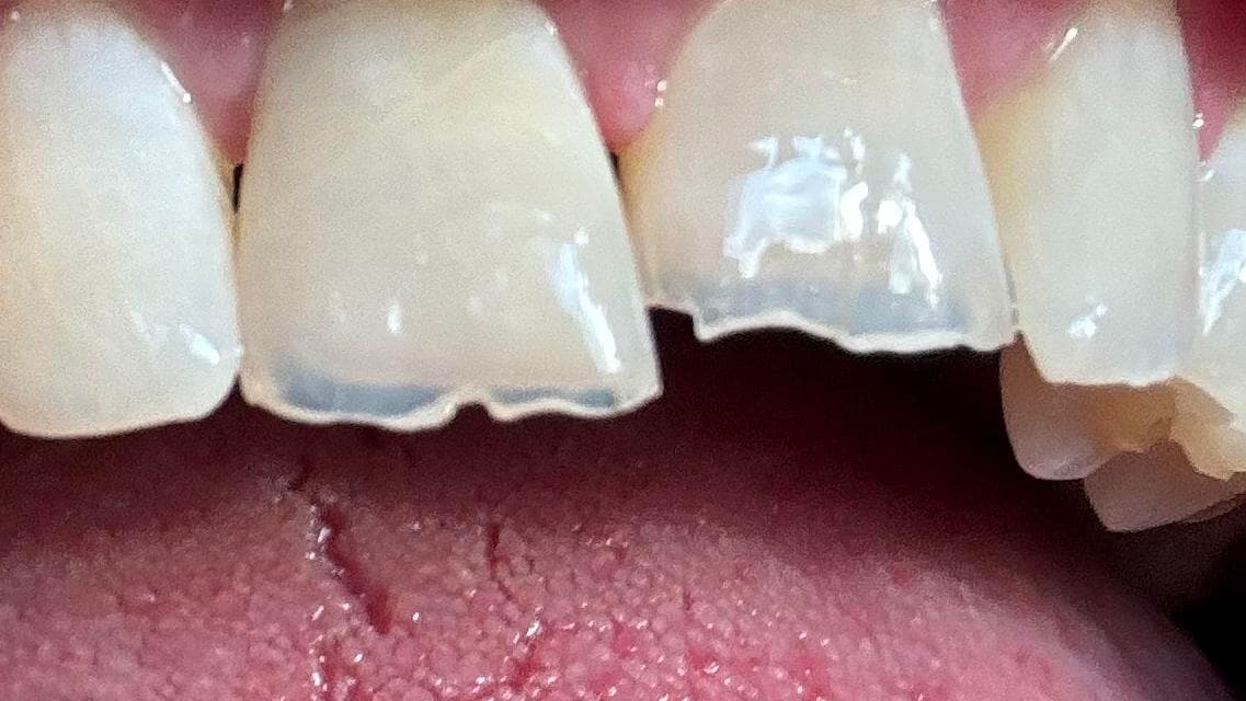 Fractured front tooth before repair by Dr. Meader at Complete Dental Care, Columbia SC
